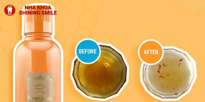 Sự Lựa Chọn Sáng Suốt Cho Nụ Cười Tươi Sáng: Nước Súc Miệng SHINING SMILE Cho Người Niềng Răng