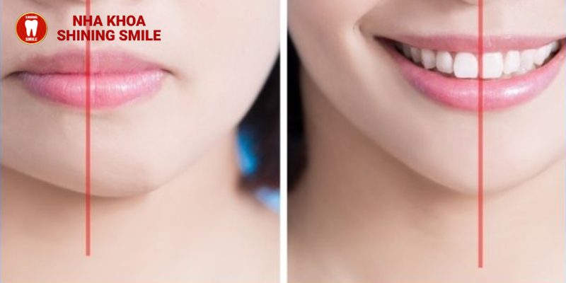 Niềng răng bị lệch mặt không còn đáng lo: Biến đổi nụ cười hoàn hảo với niềng răng Shining Smile!