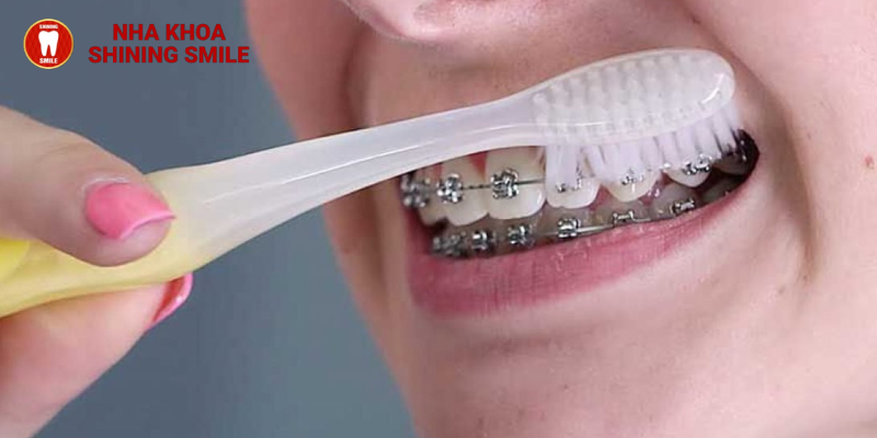 Bật mí bí quyết sở hữu nụ cười hoàn hảo với niềng răng không bị hở lợi - Đến với SHINING SMILE!