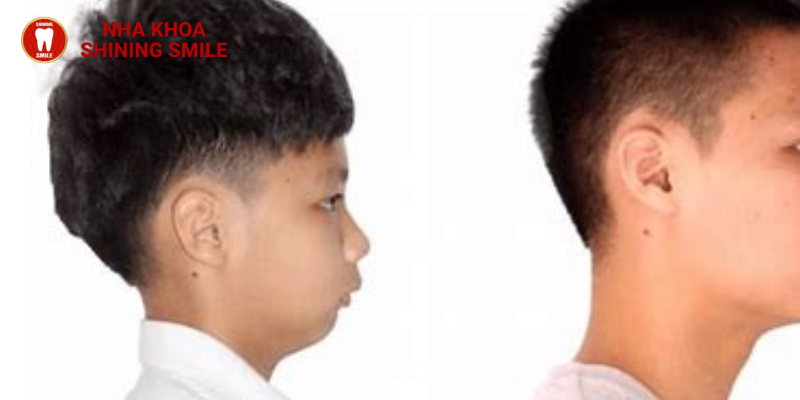 Cười tươi rạng ngời không lo cằm lẹm niềng răng tại SHINING SMILE