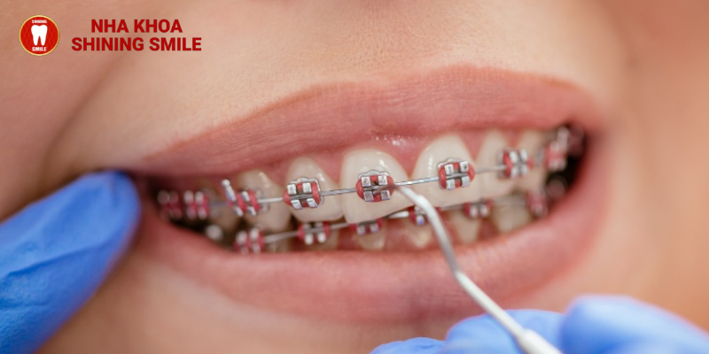 Niềng răng ở tuổi 35: Sự lựa chọn tuyệt vời cho nụ cười hoàn hảo cùng SHINING SMILE!