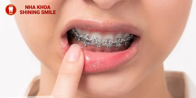 Sắc Màu Tươi Sáng Cho Nụ Cười Hoàn Hảo: Khám Phá Niềng Răng Khấp Khểnh tại SHINING SMILE!