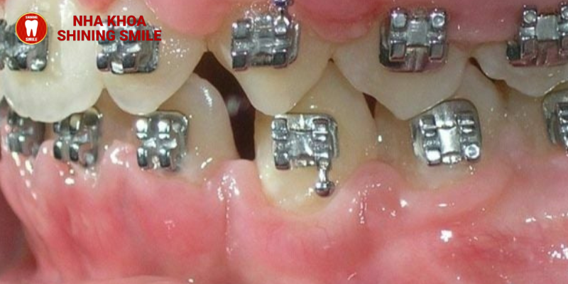 SHINING SMILE - Giải Pháp Sáng Cho Vấn Đề Niềng Răng Hỏng