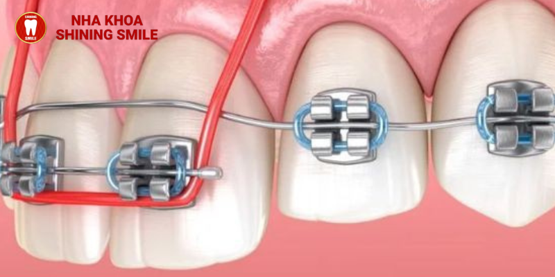 Tháo vít niềng răng: Đau đớn hay không đáng lo ngại?