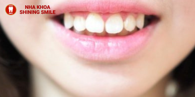 Niềng răng có làm răng yếu đi? Bí mật từ Shining Smile đã sáng tỏ!