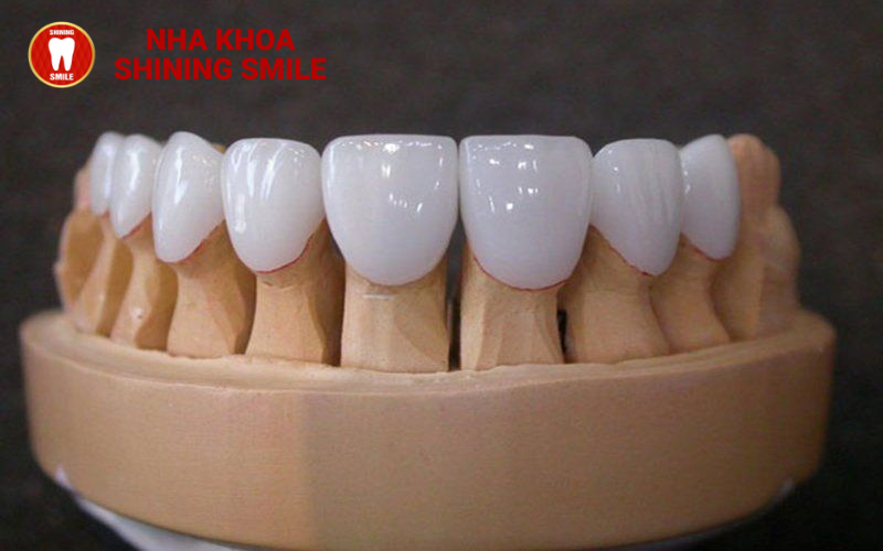 Nên Bọc Răng Sứ Loại Nào? Hướng Dẫn Chi Tiết Từ Chuyên Gia