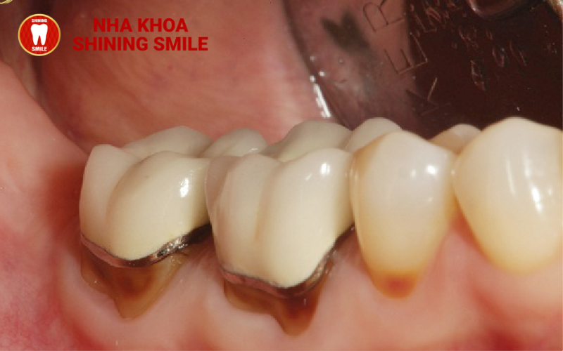 Dấu Hiệu Răng Sứ Bị Hở: Nguyên Nhân Và Cách Khắc Phục