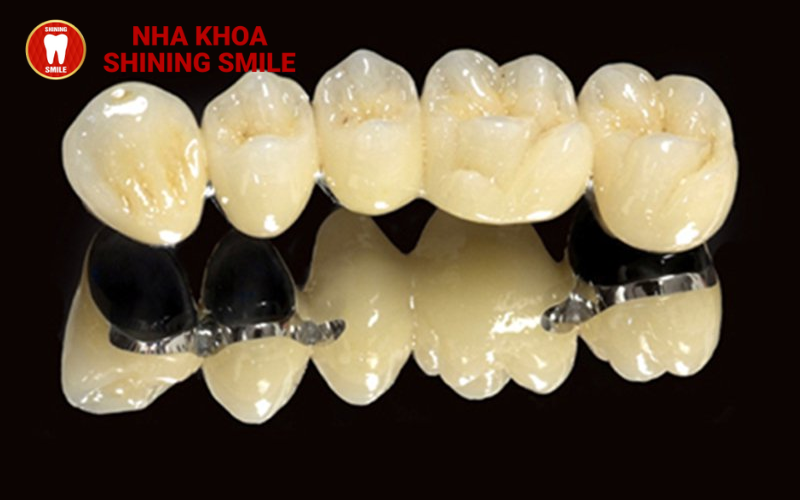 Các Loại Răng Sứ: Đặc Điểm Và Lợi Ích Từng Loại