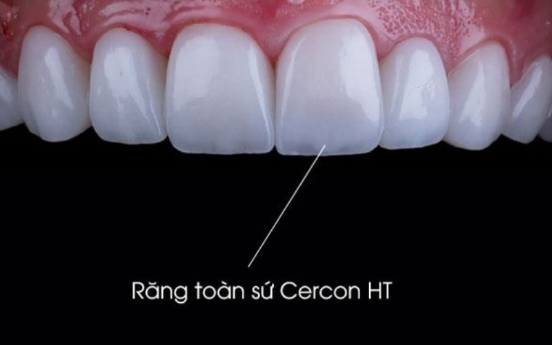 rang-su-cercon-ht-co-tot-khong-1.jpg